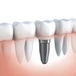 Czym są implanty zębowe?