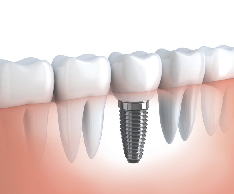 What are dental implants?