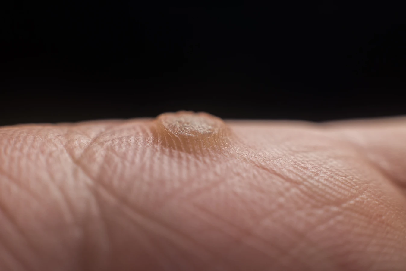 Co jest najskuteczniejsze na kurzajki?