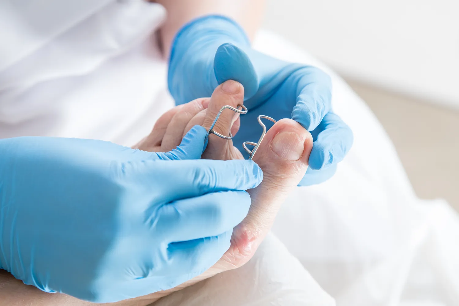 Co podolog robi z odciskami?