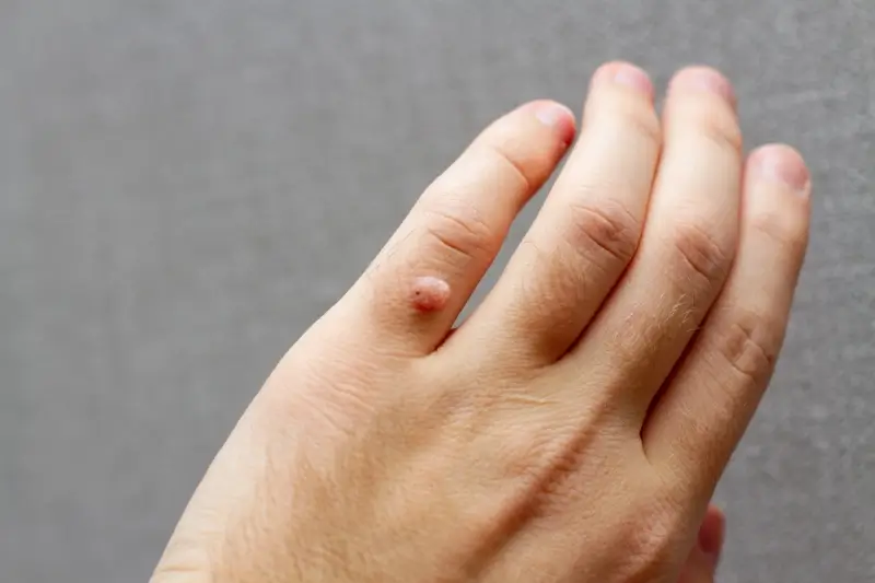 Help 4 skin kurzajki jak stosować?