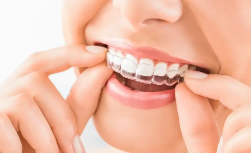 Invisalign co to jest?